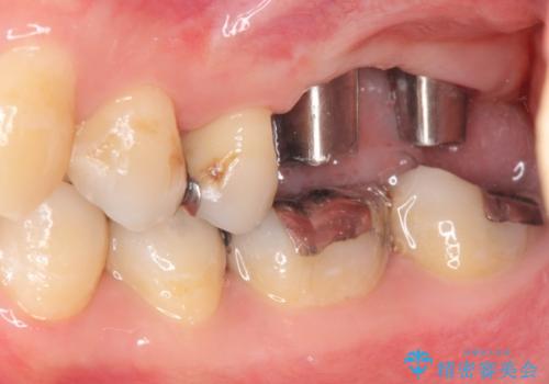 上顎奥歯のインプラント治療の治療中