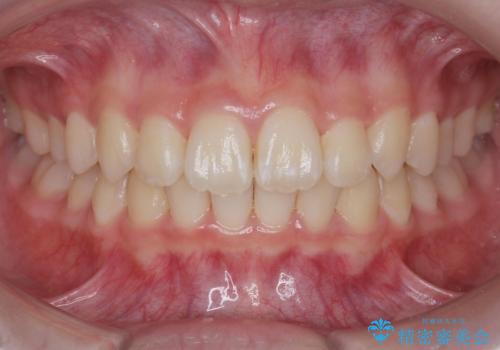 子供の出っ歯 生え代わりと成長期を利用して非抜歯で矯正の治療後