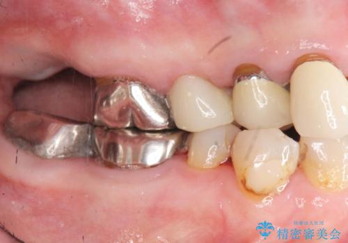 セラミック インプラント 全顎治療の治療前