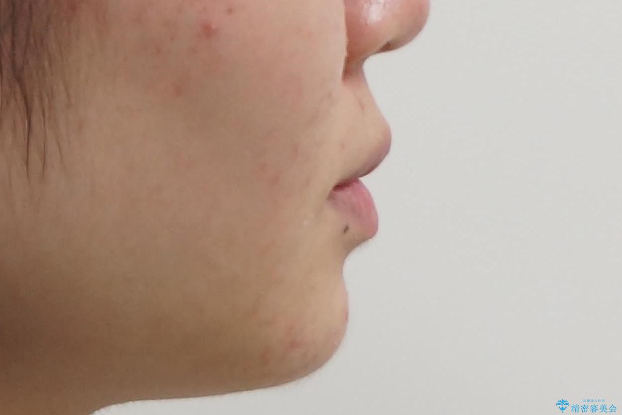 子供の出っ歯 生え代わりと成長期を利用して非抜歯で矯正の治療後(顔貌)