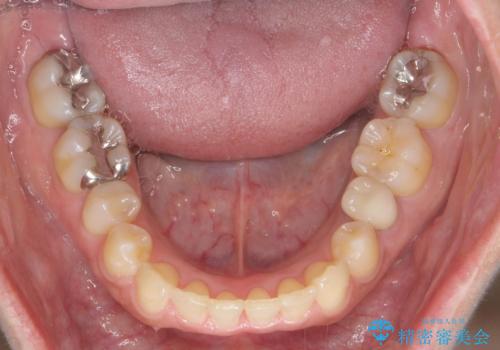 [前歯のねじれ 部分]ワイヤーとマウスピースの併用矯正治療　の治療後