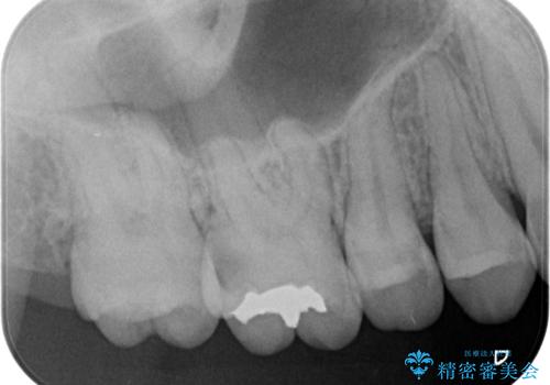 奥歯の虫歯の治療　の治療前