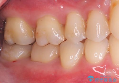 【セラミックインレー】銀の詰め物が取れたの治療後