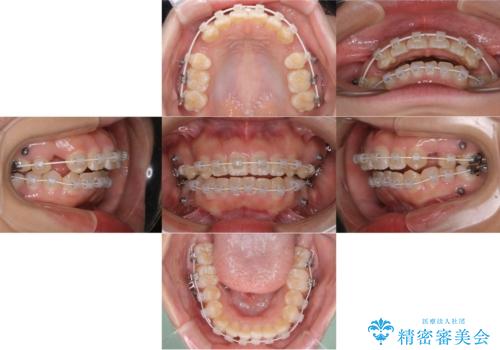 どこで噛んだらいいのかわからない:ワイヤーによる矯正治療の治療後