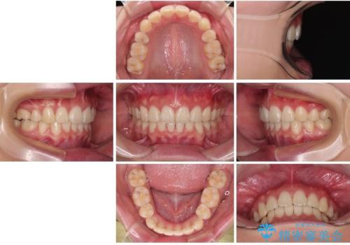 口元が出ているのを改善したい。 クリアブラケットによる抜歯矯正の治療後