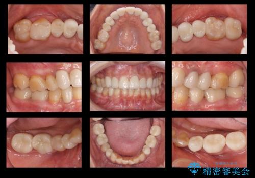 50代女性 銀歯をとって白いつめものに 全体的な治療の治療後