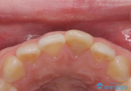 前歯の変色とガタつき ジルコニアクラウンでの修復の治療前