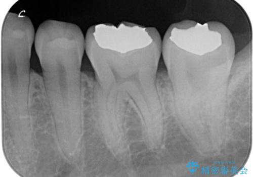 【歯に穴が空いている】ゴールドインレーで修復の治療後