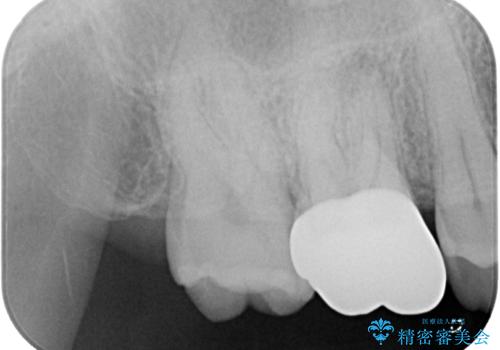 セラミックの詰め物が割れた フルジルコニアクラウンの治療後