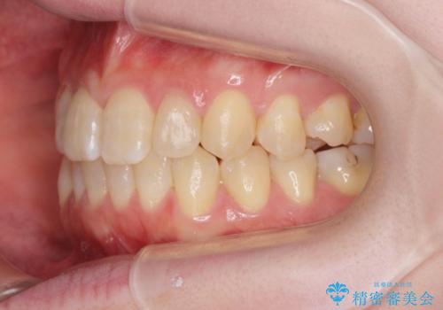 前歯のねじれを治したい リーズナブルなインビザラインモデレートプランの治療後