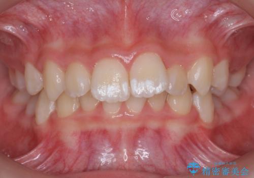 子供の出っ歯 生え代わりと成長期を利用して非抜歯で矯正の治療前