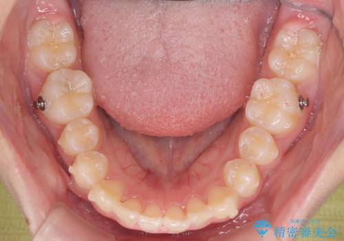 子供の出っ歯 生え代わりと成長期を利用して非抜歯で矯正の治療中