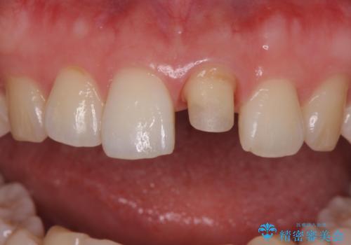 前歯の変色とガタつき ジルコニアクラウンでの修復の治療中