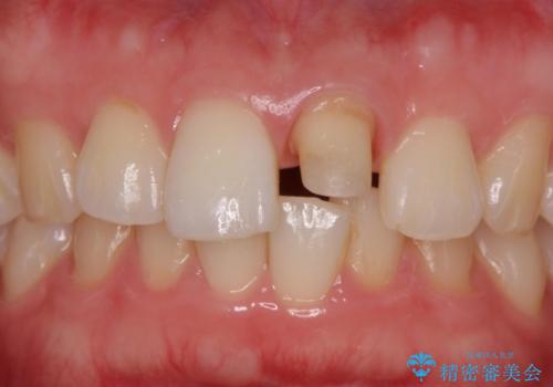 前歯の変色とガタつき ジルコニアクラウンでの修復の治療中
