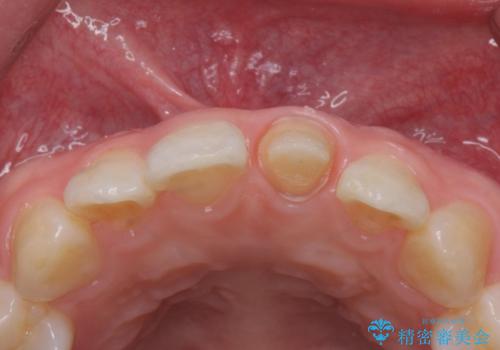 前歯の変色とガタつき ジルコニアクラウンでの修復の治療中