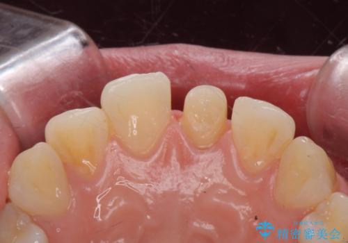 前歯の変色とガタつき ジルコニアクラウンでの修復の治療中