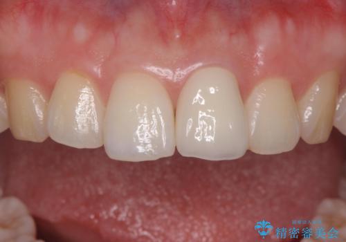 前歯の変色とガタつき ジルコニアクラウンでの修復の治療後