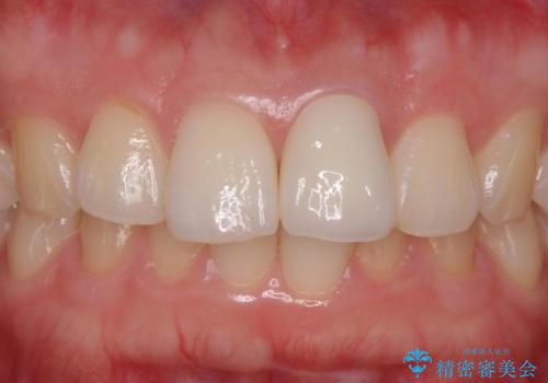 前歯の変色とガタつき ジルコニアクラウンでの修復の治療後