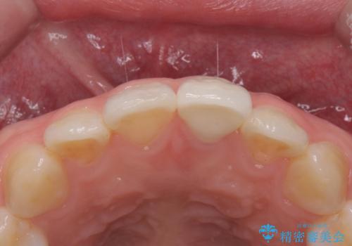 前歯の変色とガタつき ジルコニアクラウンでの修復の治療後