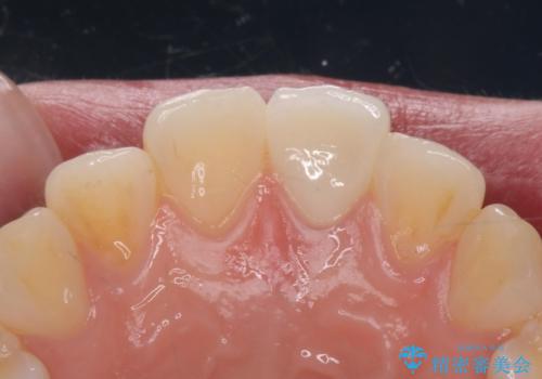 前歯の変色とガタつき ジルコニアクラウンでの修復の治療後