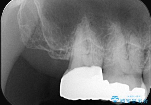 【フルジルコニアクラウン】銀歯二次カリエス!の治療後