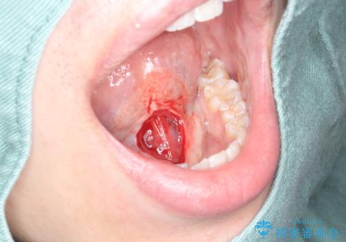 「サ行」が発音しづらい 舌小帯形成術で改善の治療中