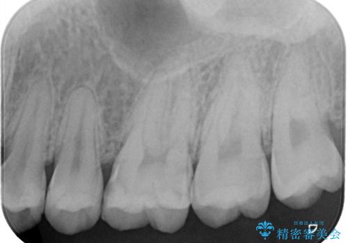 神経を守る治療 即日セラミック修復の治療前