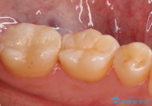奥歯の保険材料を自費でやり直したいの治療後