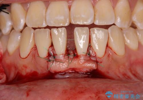 半分以上歯根が見えている　歯肉移植による根面被覆術の治療中