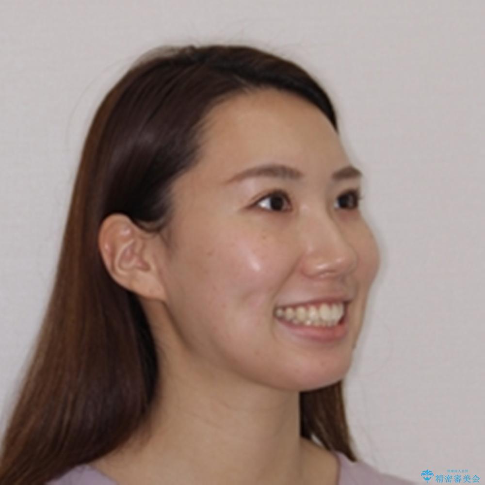 【モニター】前に傾斜した前歯 インビザラインでスッキリとした口元にの治療前(顔貌)