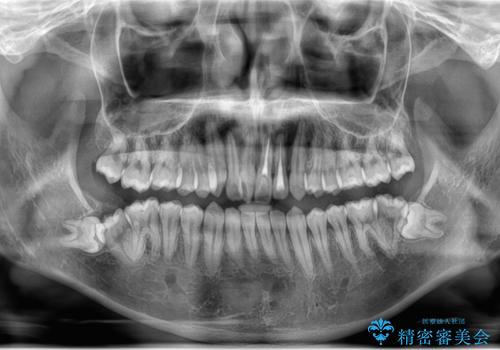 右下親知らず抜きたい。の治療前