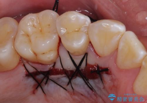 半分以上歯根が見えている 歯肉移植による根面被覆術の治療中