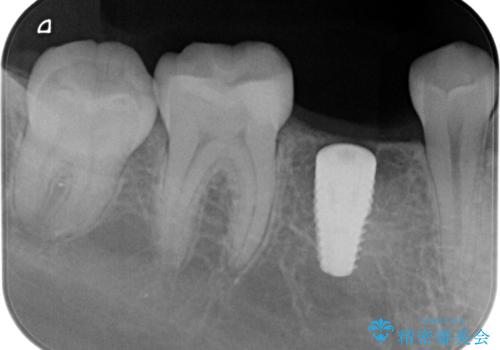インプラント治療の治療中
