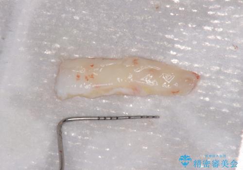 半分以上歯根が見えている 歯肉移植による根面被覆術の治療前