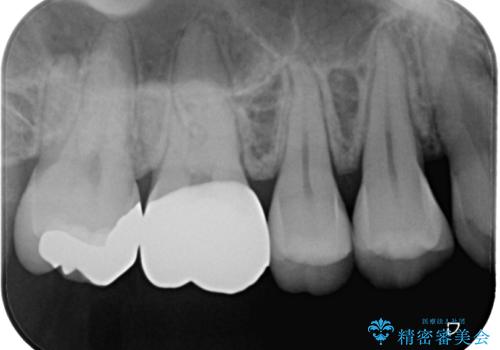 銀歯をやり替えたい　フルジルコニアクラウン・ゴールドインレー修復の治療後