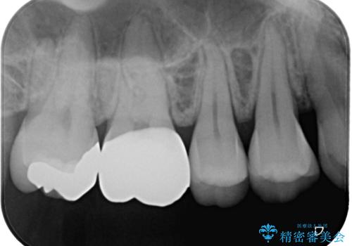 銀歯をやり替えたい フルジルコニアクラウン・ゴールドインレー修復の治療後