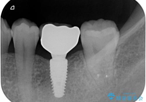 大臼歯の欠損 インプラント治療の治療後