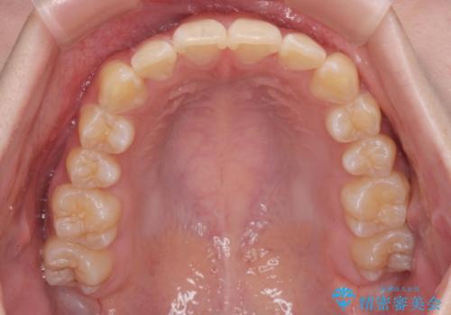 前歯のがたつき気になる。インビザラインモデレートの治療後
