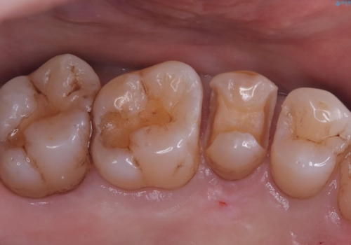【セラミックインレー】海外に行く前に虫歯治療してほしいの治療中