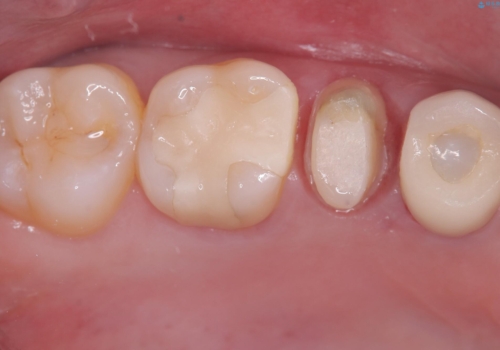 【セラミッククラウン】銀の詰め物していた歯が割れたの治療中