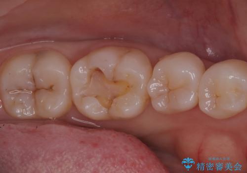 【セラミックインレー】噛む面が青白い気がするの治療中