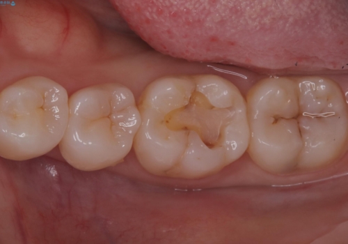 【セラミックインレー】噛む面が青白い気がするの治療中