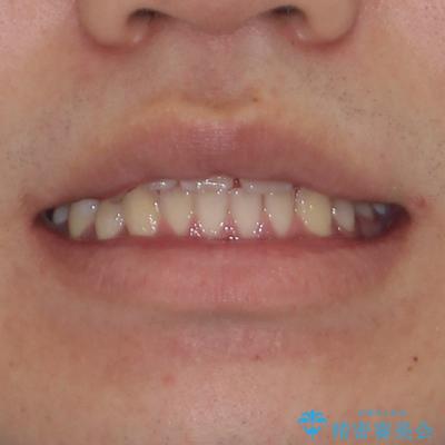 目立つ八重歯を非抜歯矯正で整える 目立たないワイヤー矯正の治療前(顔貌)