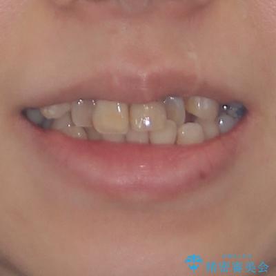 気になる八重歯と変色した前歯 抜歯矯正とセラミッククラウン治療の治療前(顔貌)