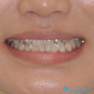 全く目立たないワイヤー矯正 上下裏側矯正の治療前(顔貌)