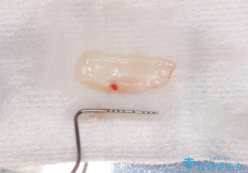半分以上歯根が見えている 歯肉移植による根面被覆術の治療前