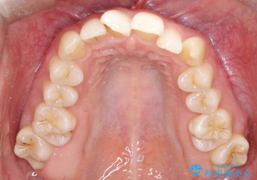 前歯のガタガタと欠損部を改善の治療前