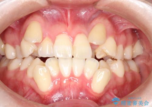 【ワイヤー矯正】八重歯 歯のでこぼこを治したい!の症例 治療前