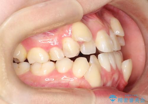 【ワイヤー矯正】八重歯 歯のでこぼこを治したい!の治療前