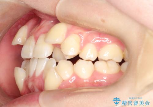 【ワイヤー矯正】八重歯 歯のでこぼこを治したい!の治療前